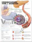 Understanding Type 1 Diabetes Anatomical Chart, Second Edition